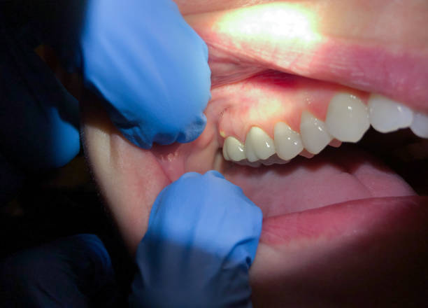 Best Emergency Treatment for Dental Infections or Abscesses in Big Stone Gap, VA